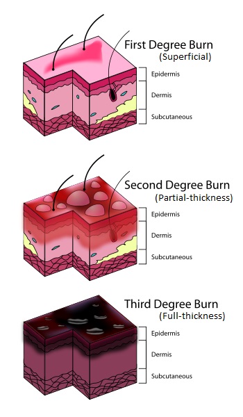 Burn types