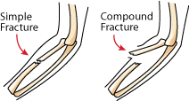 Fracture types