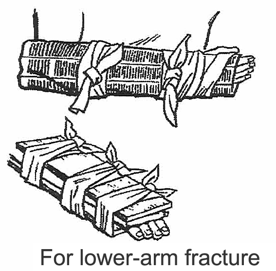 Lower arm fracture